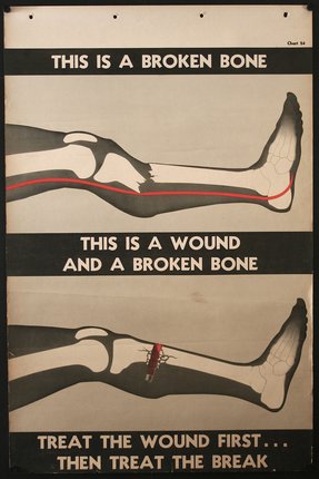 a poster showing bones and a broken bone